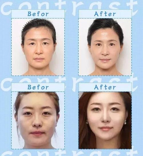 北京八大处做拉皮哪个医生好？杨欣赵延勇侯典举面部拉皮哪个好？