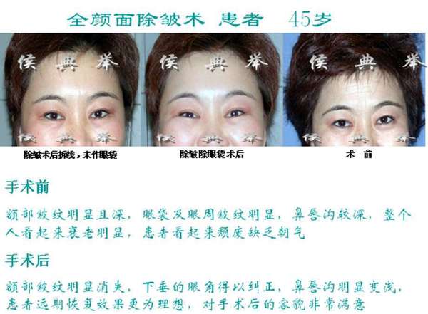 北京八大处做拉皮哪个医生好？杨欣赵延勇侯典举面部拉皮哪个好？