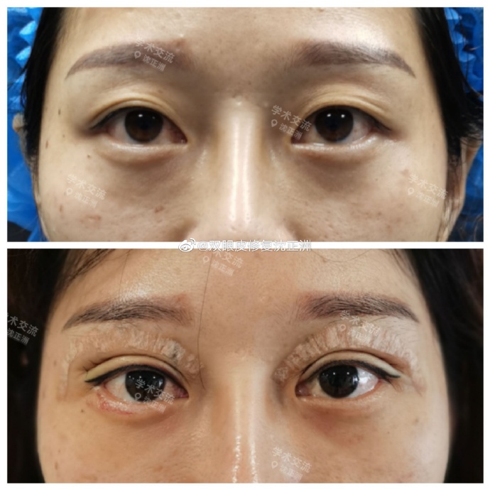 沈正洲做双眼皮案例