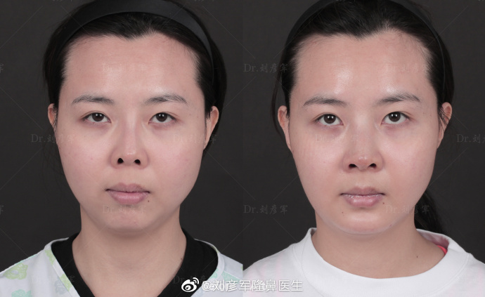 刘彦军做鼻修复案例