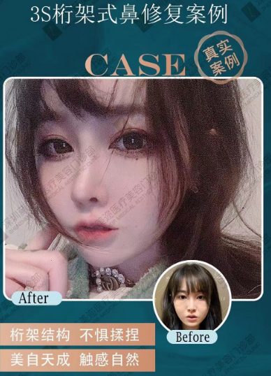 朱灿鼻修复案例
