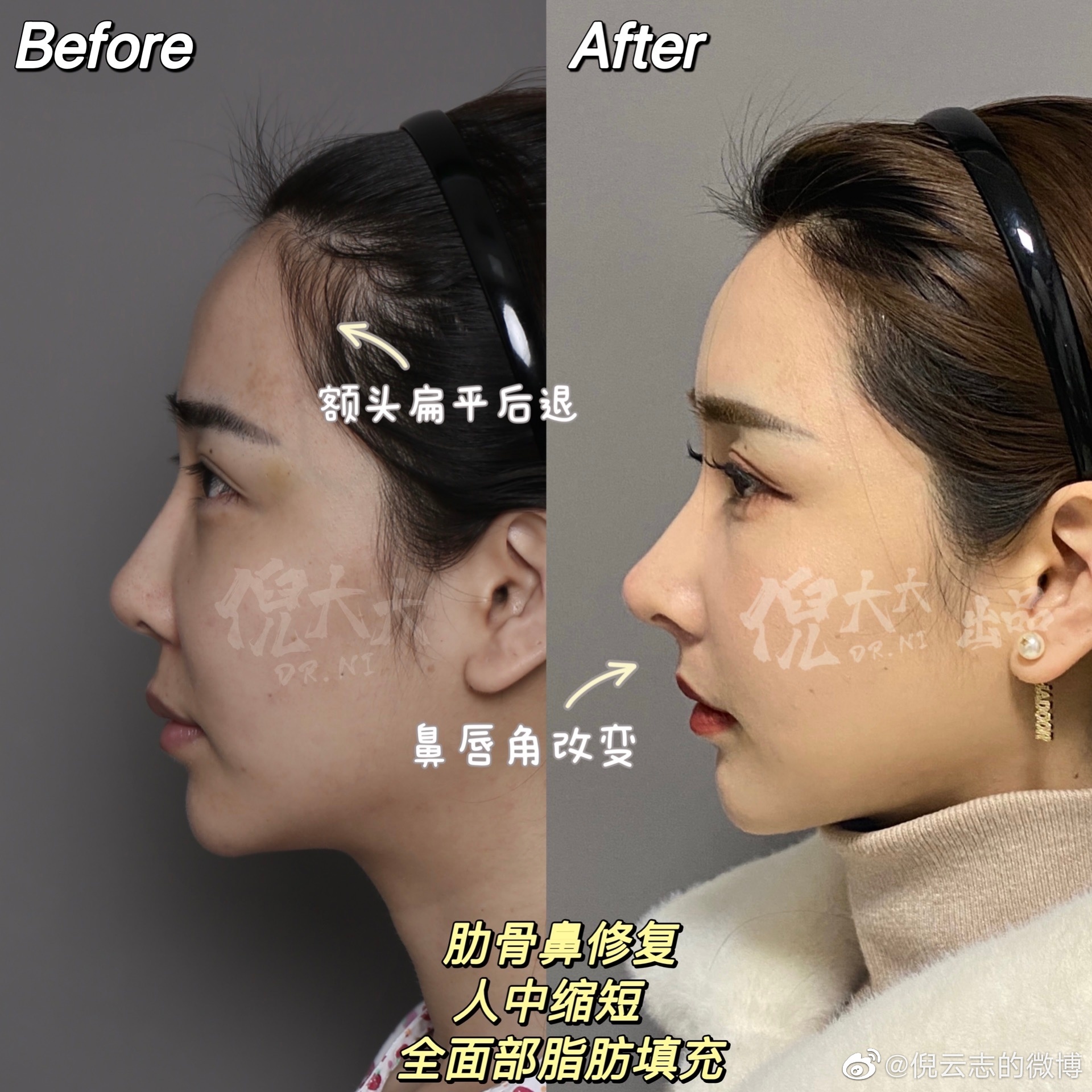 倪云志做鼻子修复案例