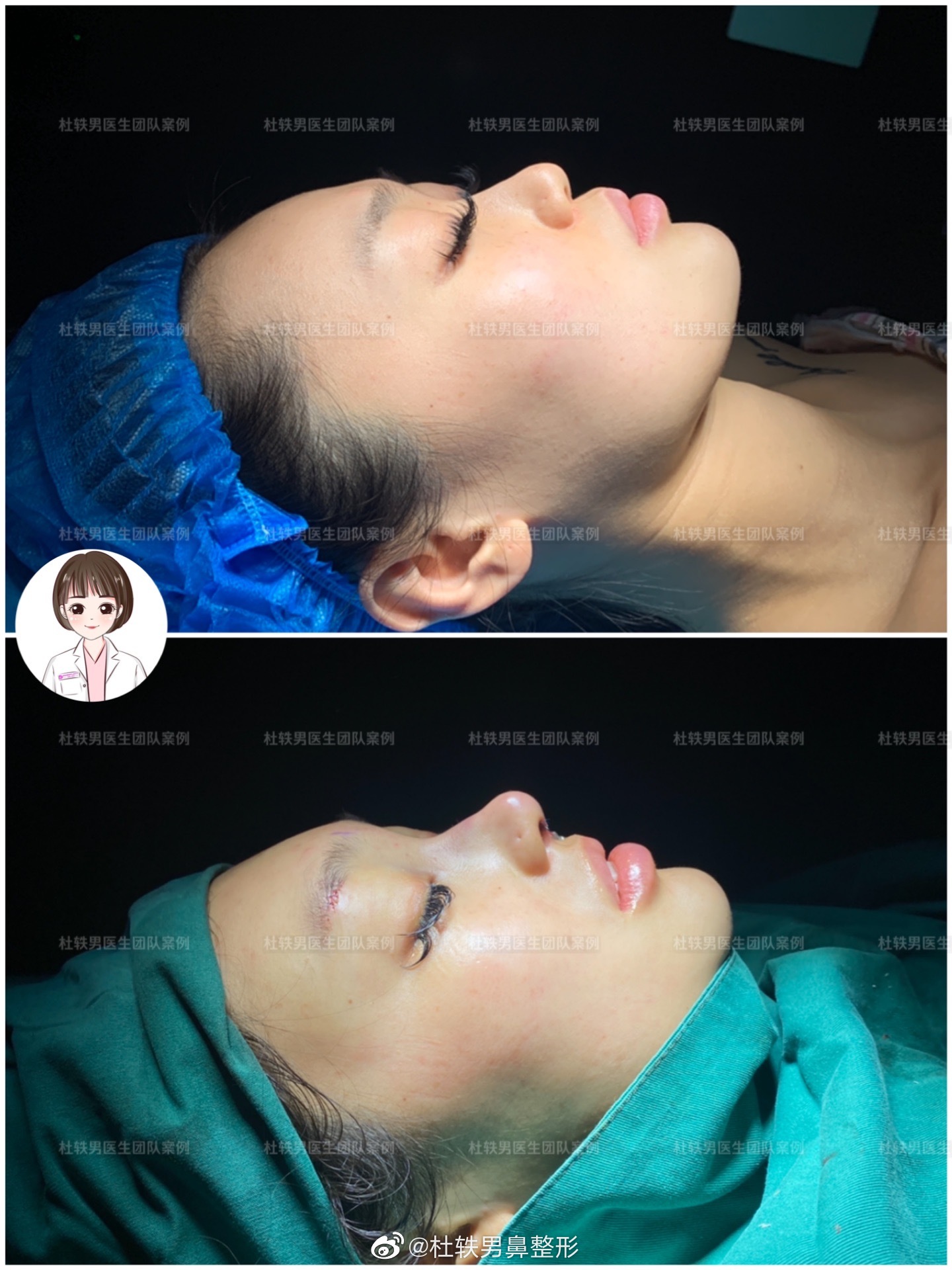 杜轶男做鼻子案例