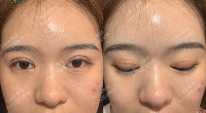 李勇双眼皮修复案例