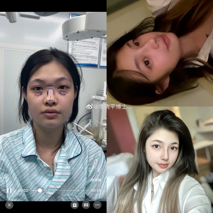 李晓平做鼻子案例