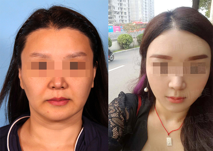面部拉皮案例