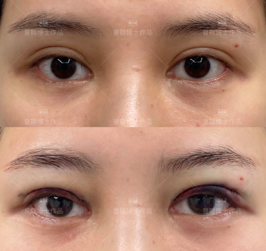 双眼皮修复案例