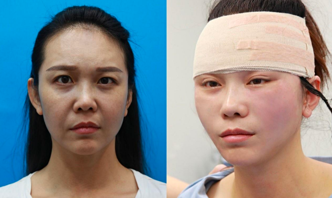 王克明拉皮案例