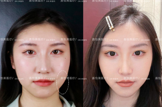 李国伟面部吸脂案例