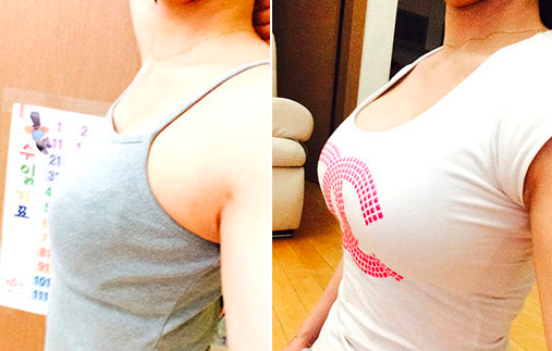 李楠假体丰胸案例