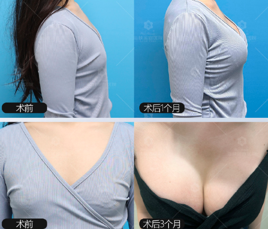 林沸腾内窥镜隆胸案例