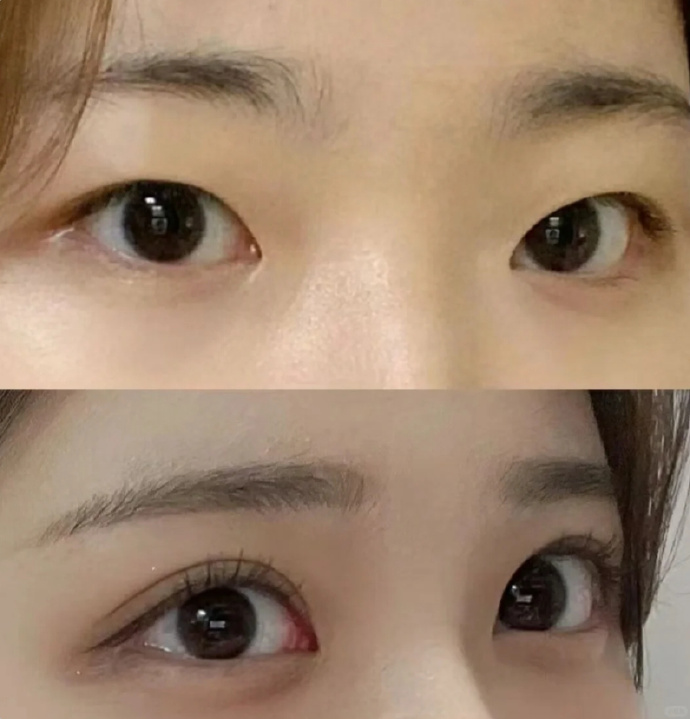 杭州双眼皮案例