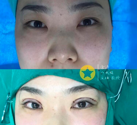 宋涛双眼皮案例