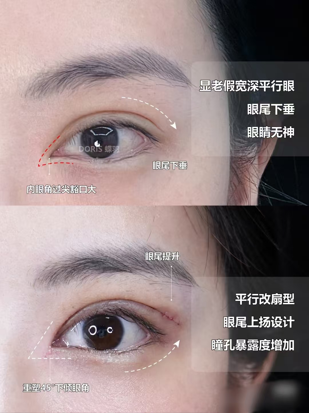 双眼皮修复