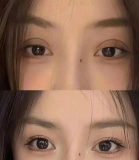 马娟双眼皮修复案例