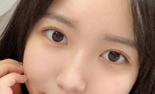 北京双眼皮