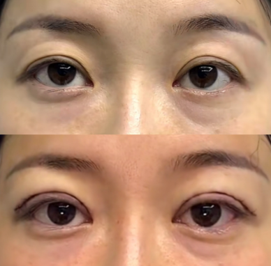 上海双眼皮修复最牛的医生是哪个?马娟、郑小红、张楚、曾翾、杜园园?