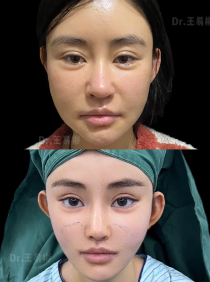 上海王易彬3D钻石网提升效果好不好?王易彬面部提升大概价位多少?