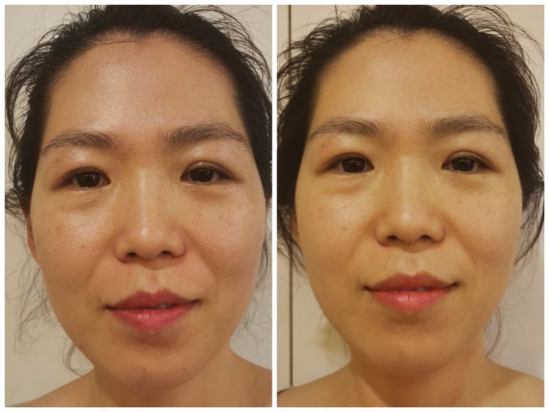 成都陈旭东医生做面部微调技术好不好?陈旭东注射价格贵不贵?