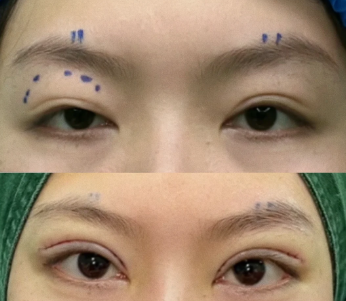 双眼皮修复