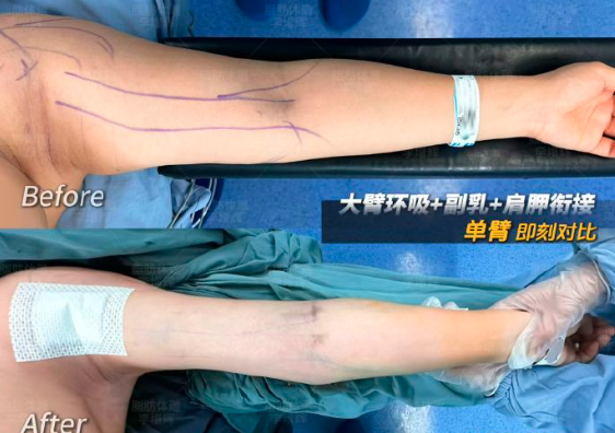 李增辉吸脂案例