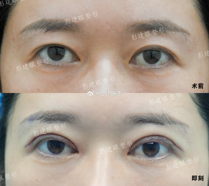 彭建双眼皮修复案例