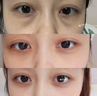 宋春琼去眼袋案例