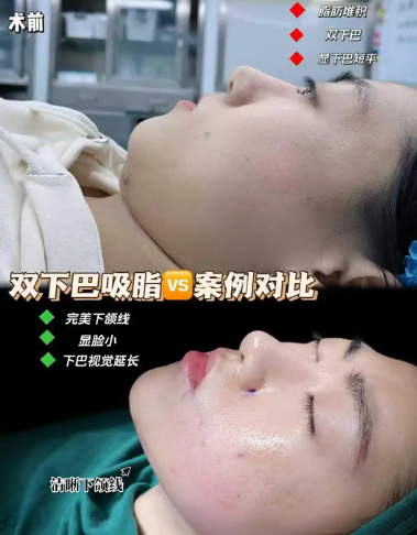 2026年深圳脂肪填充哪个医生技术最好?深圳吸脂技术好的医生预约排名?