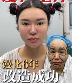 广州馒化修复医生金洪尧技术怎么样?金洪尧馒化修复收费贵不贵?