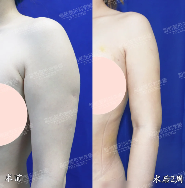 上海刘李娜吸脂技术怎么样?刘李娜体雕效果好不好?