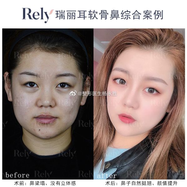 哈尔滨杨永胜和黄志祥哪个医生隆鼻技术好？杨永胜和黄志祥口碑谁好？