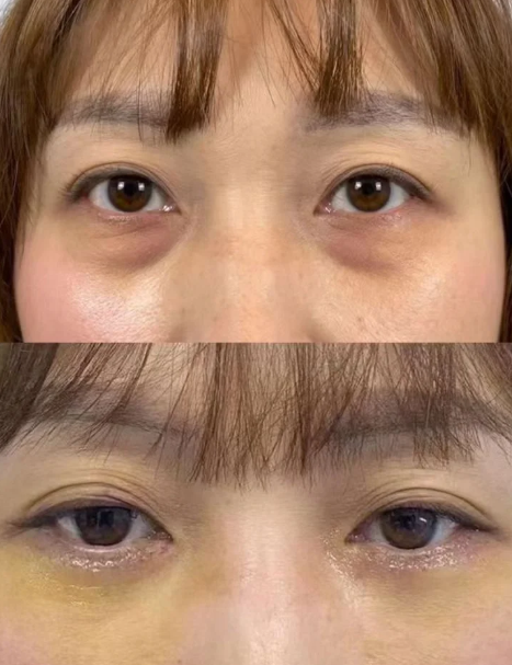 陈志敏祛眼袋案例