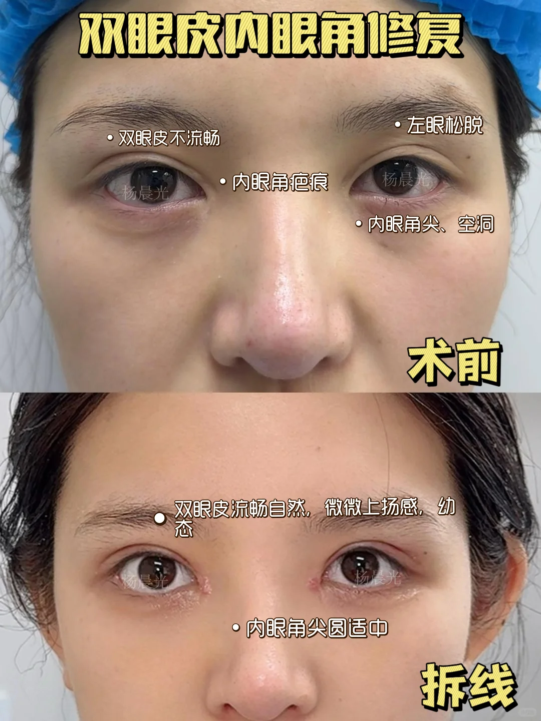 杨晨光眼修复案例