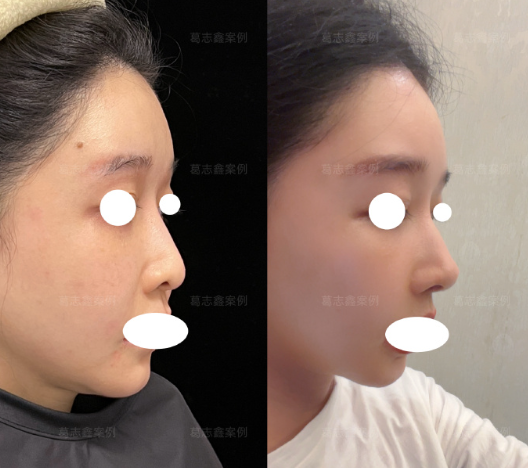 葛志鑫鼻修复案例