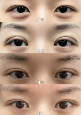 邵建川双眼皮修复案例