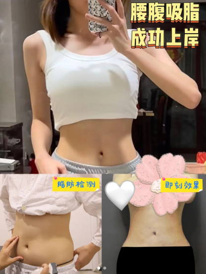吸脂案例