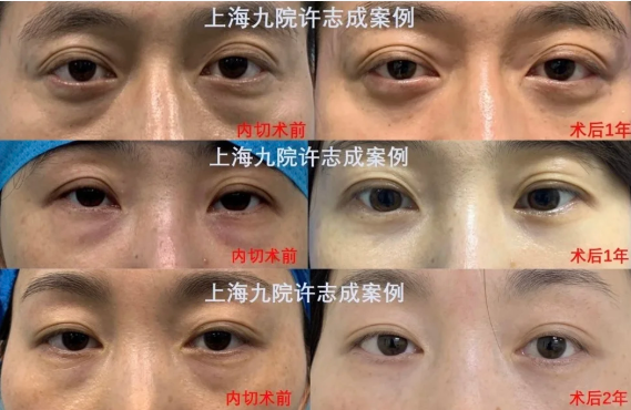 许志成祛眼袋案例