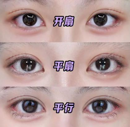 罗施双眼皮案例