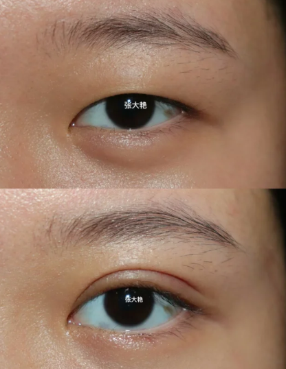 张大艳双眼皮案例