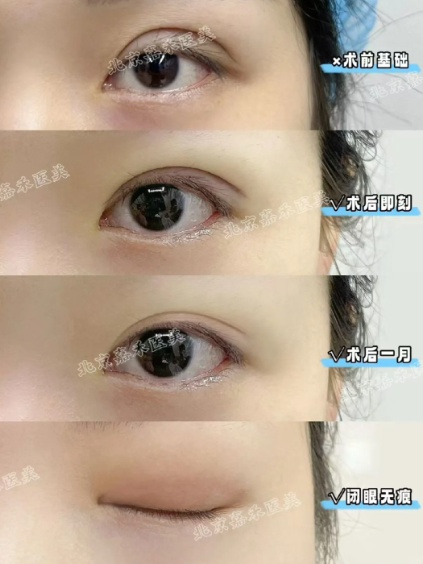 李燕双眼皮案例