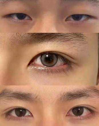 马媛双眼皮案例