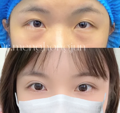 孟洪君双眼皮案例