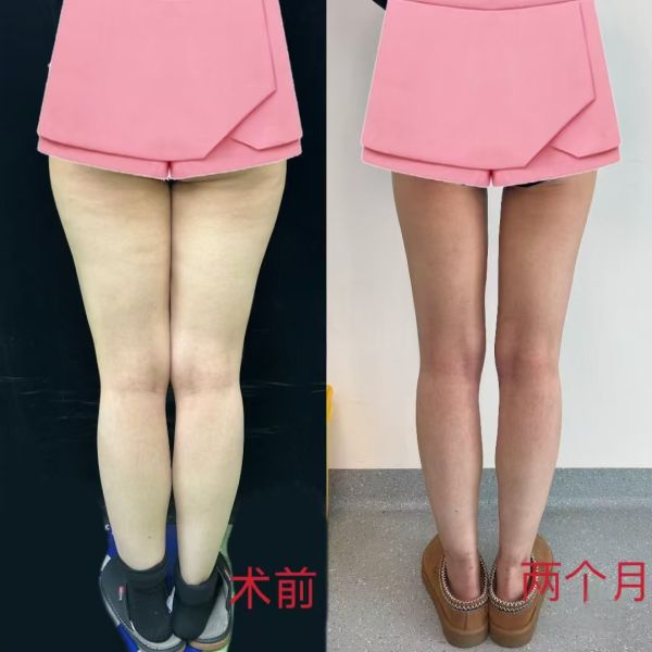 北京八大处吸脂技术最好的医生吕倩雯、杨增杰、陈博、王维新、李发成、顾云鹏谁厉害?