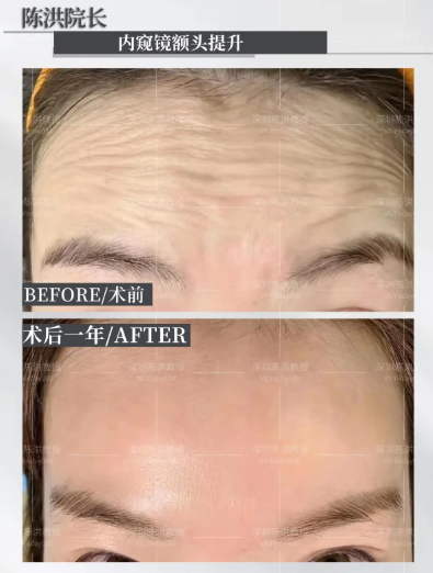 深圳拉皮专家陈洪和张陈威哪个医生做面部提升年轻化技术好?