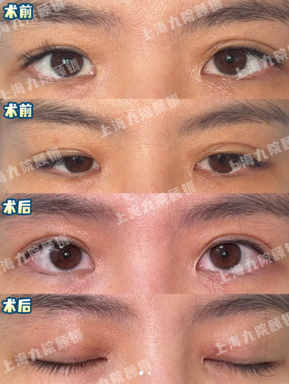 上海九院双眼皮修复医生哪个好？顾钏、金锐、周显玉、王俊芳、马昊眼修复谁厉害？
