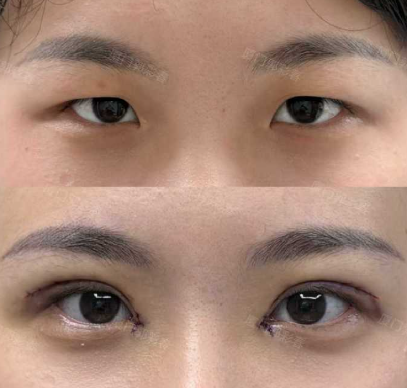 厦门双眼皮郭彩春和张帆哪个医生做的好？郭彩春和张帆做双眼皮谁好？