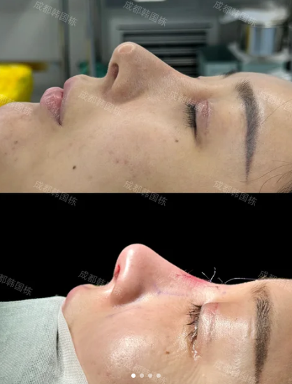 成都鼻修复韩国栋和徐航哪个医生好?韩国栋和徐航隆鼻修复谁更好?