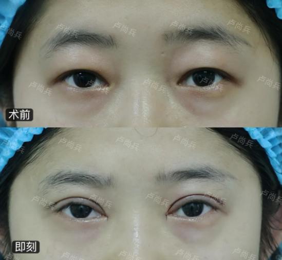 成都眼修复专家卢尚兵和高亮哪个医生做双眼皮修复好?