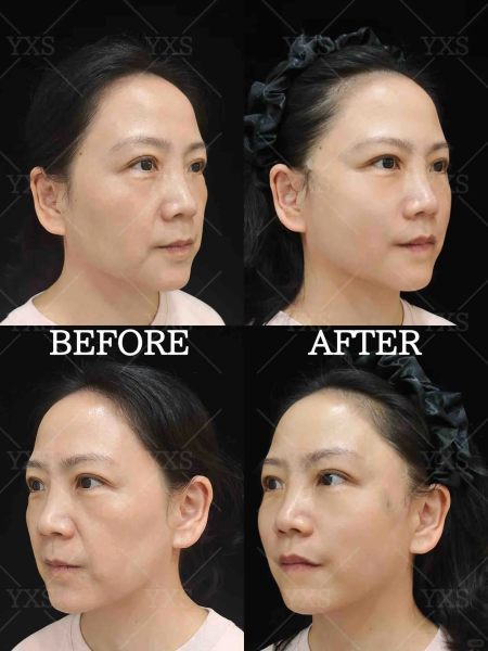 深圳高志文和王乙立做面部提升哪个技术好？谁面部年轻化技术保持时间久？