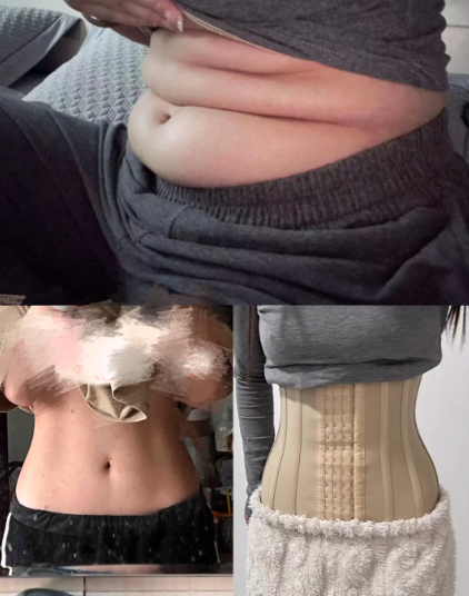 郑州有没有好的吸脂医生推荐？汪洋、李永峰、王瑞尧、罗明生、李胜旭谁吸脂更好？